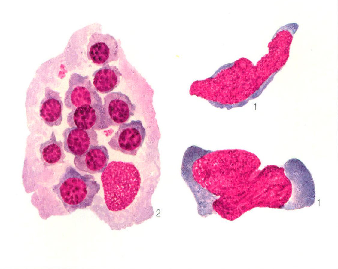 图248 恶性组织细胞病异常组织细胞和吞噬型组织细胞